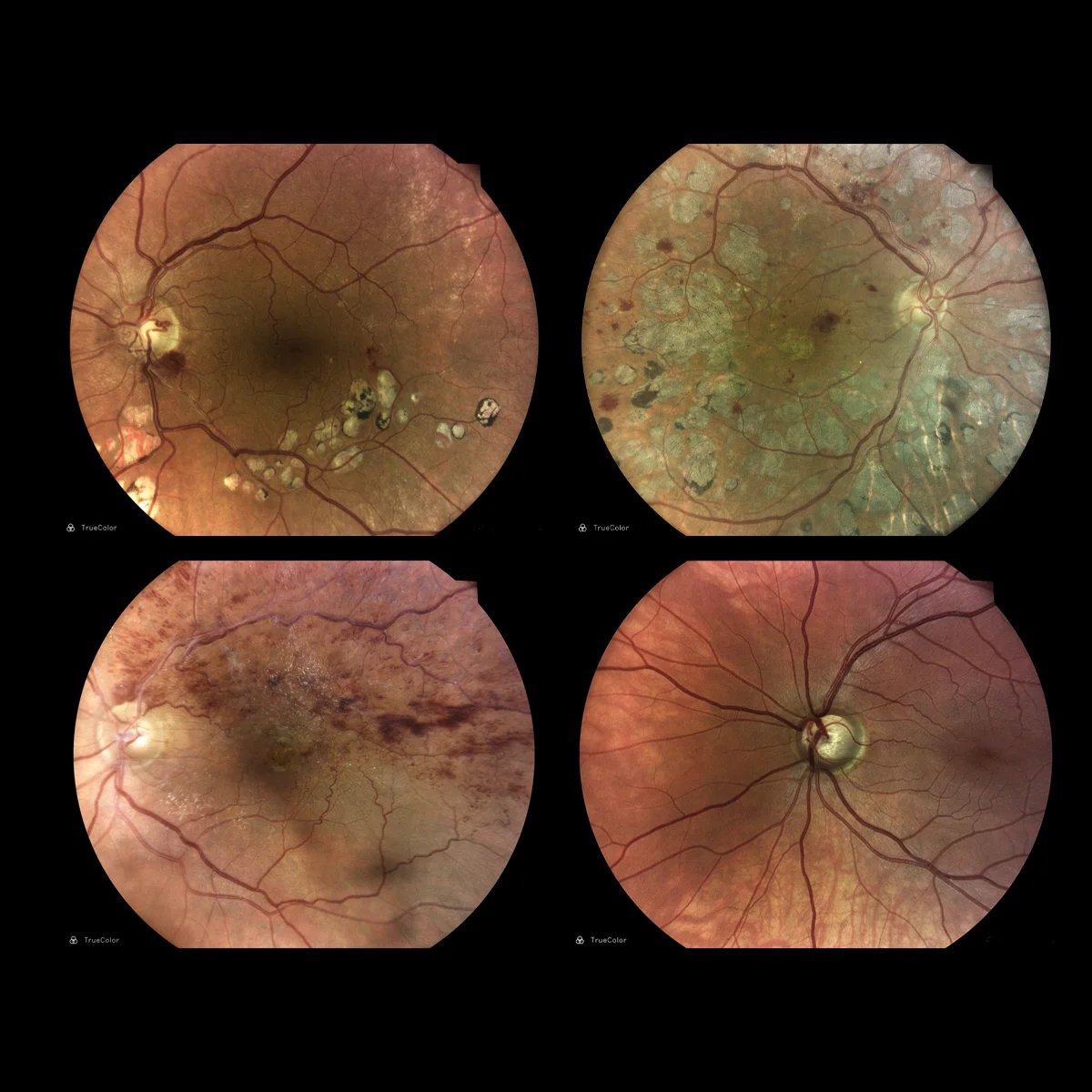 Tecnologia confocal TrueColor com LED branco proporciona imagens retinianas detalhadas a 45°